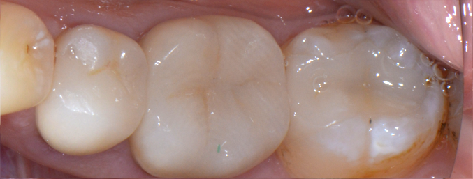 APRES - inlay onlay - dr clement robert - dentiste - Lille