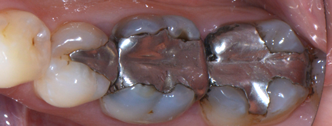 AVANT - inlay onlay - dr clement robert - dentiste - Lille