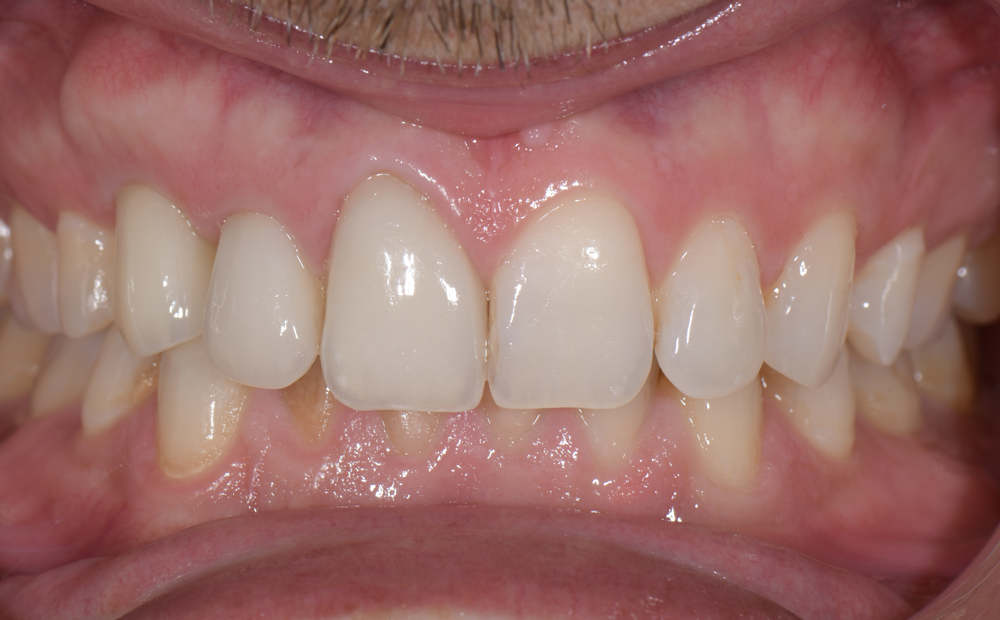 Couronne-apres-dr-clement-robert-dentiste-lille