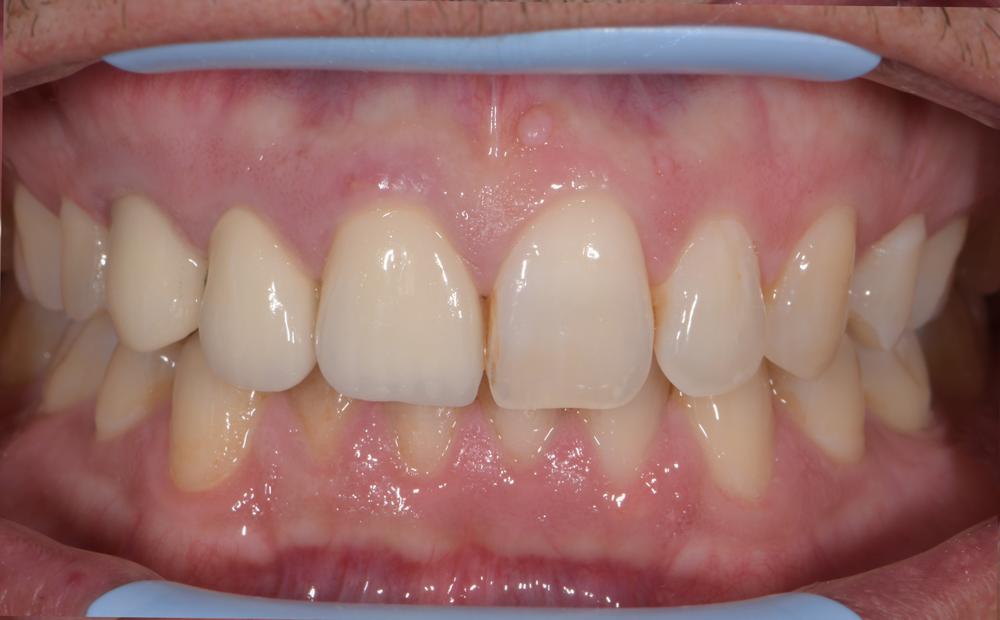 Couronne-avant-dr-clement-robert-dentiste-lille